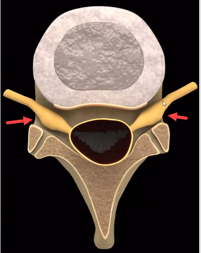 "Targeting Disc Pain: The Role of the Multifidus Muscle and ARP Neurological Treatment"