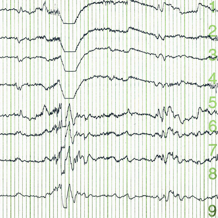 JAMA Neurology Author Interviews