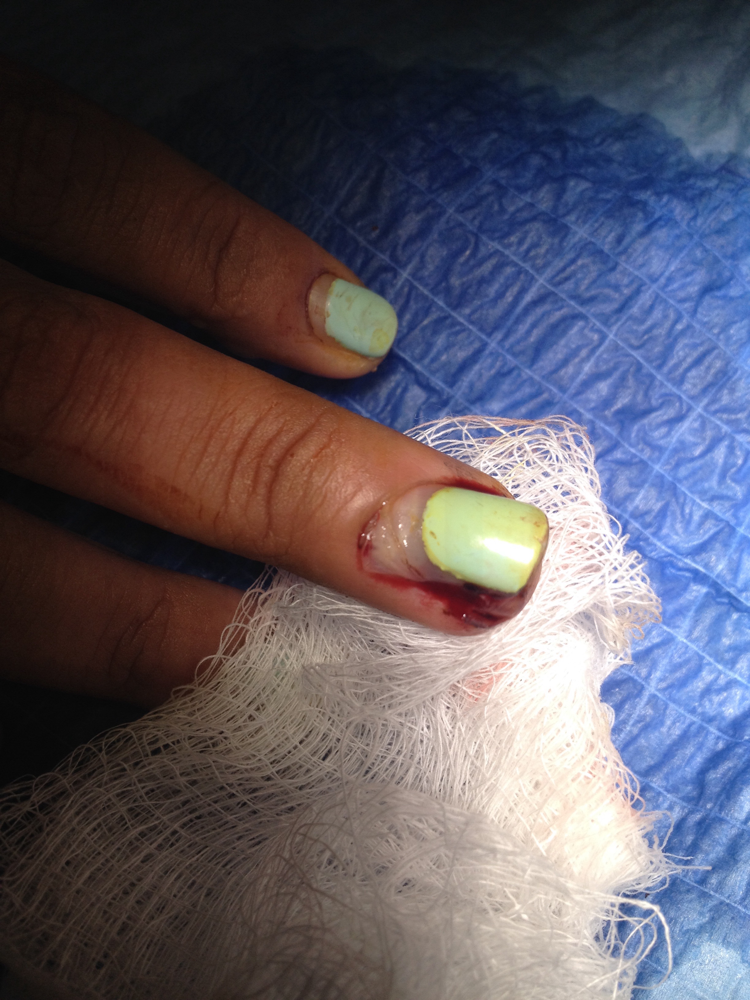 Podcast 699: Pediatric Fingernail Avulsions