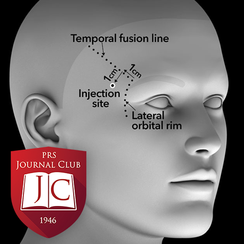 VYC-20L to Correct Temple Hollowing" with Lara Devgan, MD, MPH - Jul. 2025 Journal Club