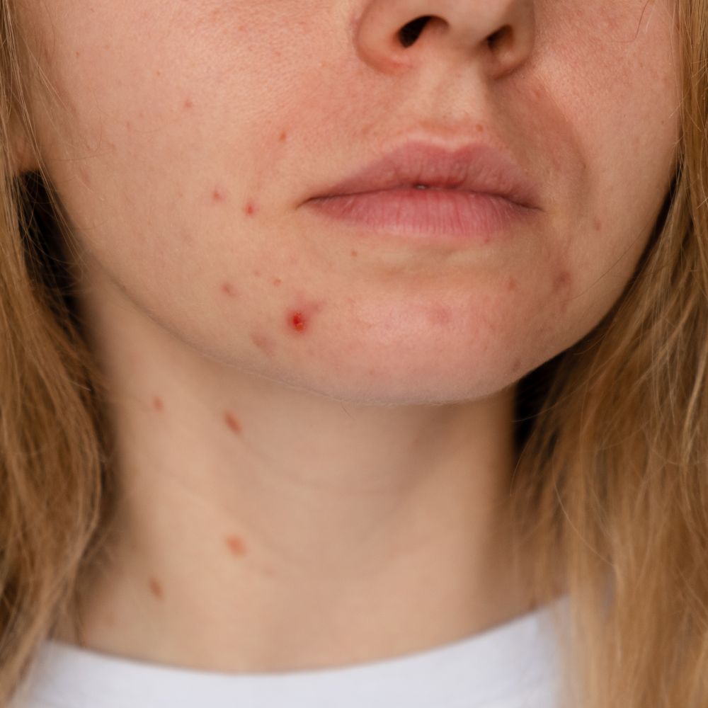 29. Understanding and Tackling Hormonal Acne